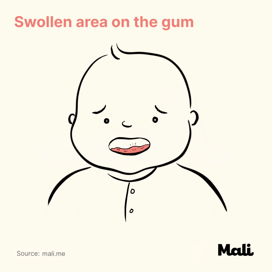 Swollen area on the gum_6 ways to determine whether your baby is sick or teething? by Mali
