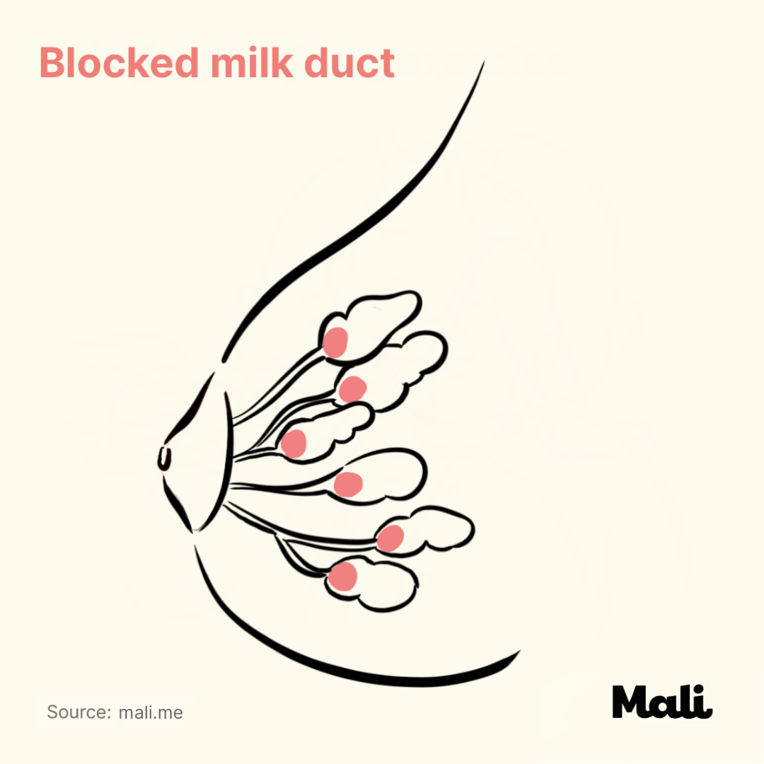Blocked milk duct_15 problems with breastfeeding by Mali