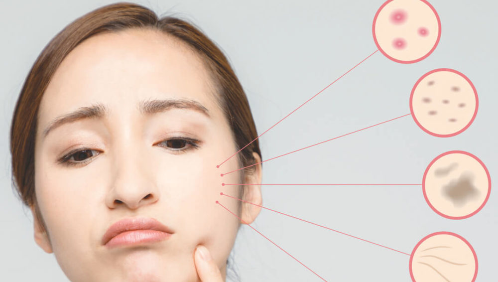 Khuôn mặt mẹ bầu có thể xuất hiện một số thay đổi ở giai đoạn đầu thai kỳ do hormone tăng cao