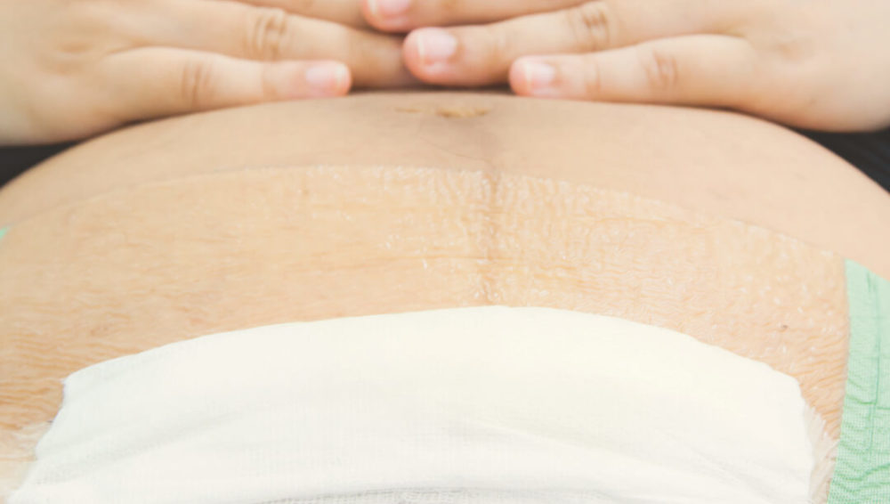 Possible causes for C-section
